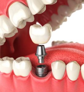 clinicas ortodoncia punta cana Tu Dentista RD