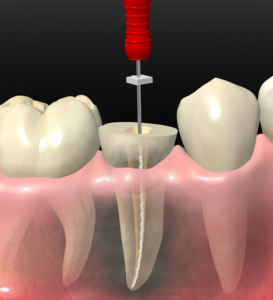 cursos implantologia dental punta cana Tu Dentista RD